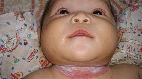 Meskipun banyak terjadi pada bayi, orang dewasa yang menggunakan popok juga dapat mengalami nya. DuniaUmmiNadia ~ Inilah kehidupanku: Rawatan Ruam ...