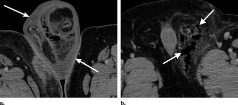 We did not find results for: Fournier gangrene in a 49-year-old man. (a, b) CT scans ...